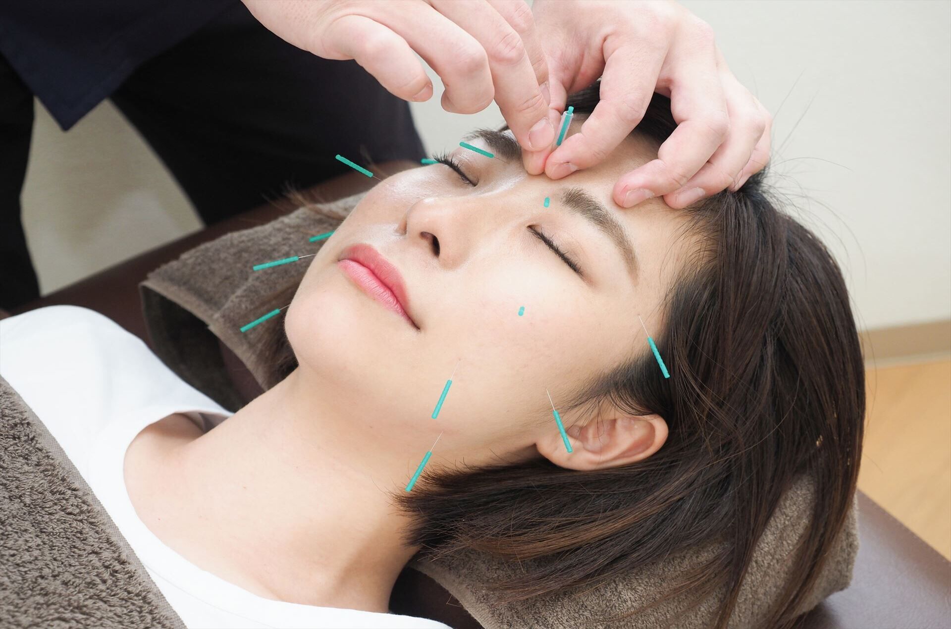 美容鍼