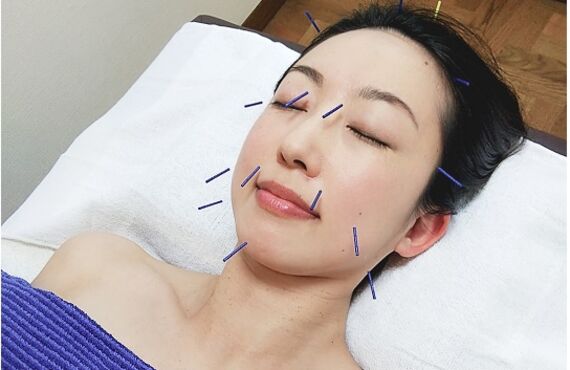 東京でたるみ改善するなら美容鍼で。Milagroはり灸院